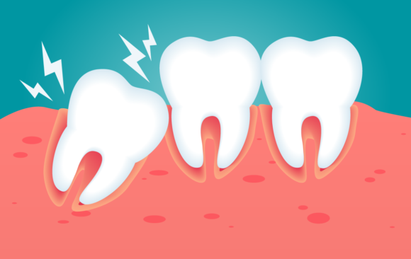 Denti storti: cause, caratteristiche, rischi e rimedi